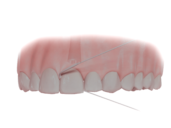 Einzelzahn Superfloss
