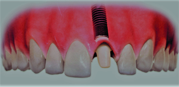 Implantatversorgung