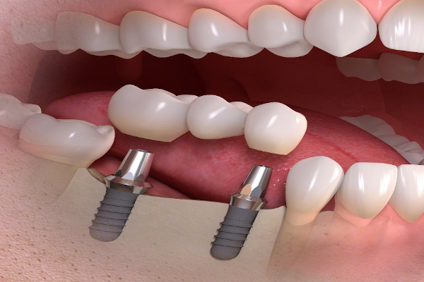 Wie wird das Implantat gesetzt?