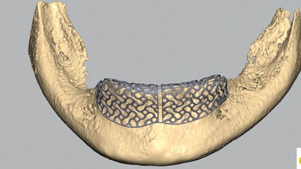 Reoss System