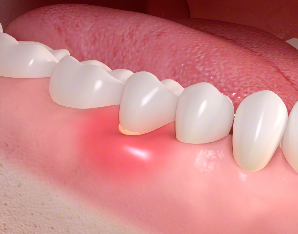 Periimplantitis