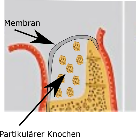 Kieferaufbau Membran