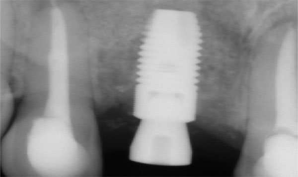 Röntgenbild Implantat