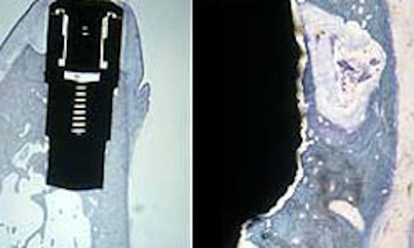 Mikroskopisches Bild eines eingeheilten Implantats