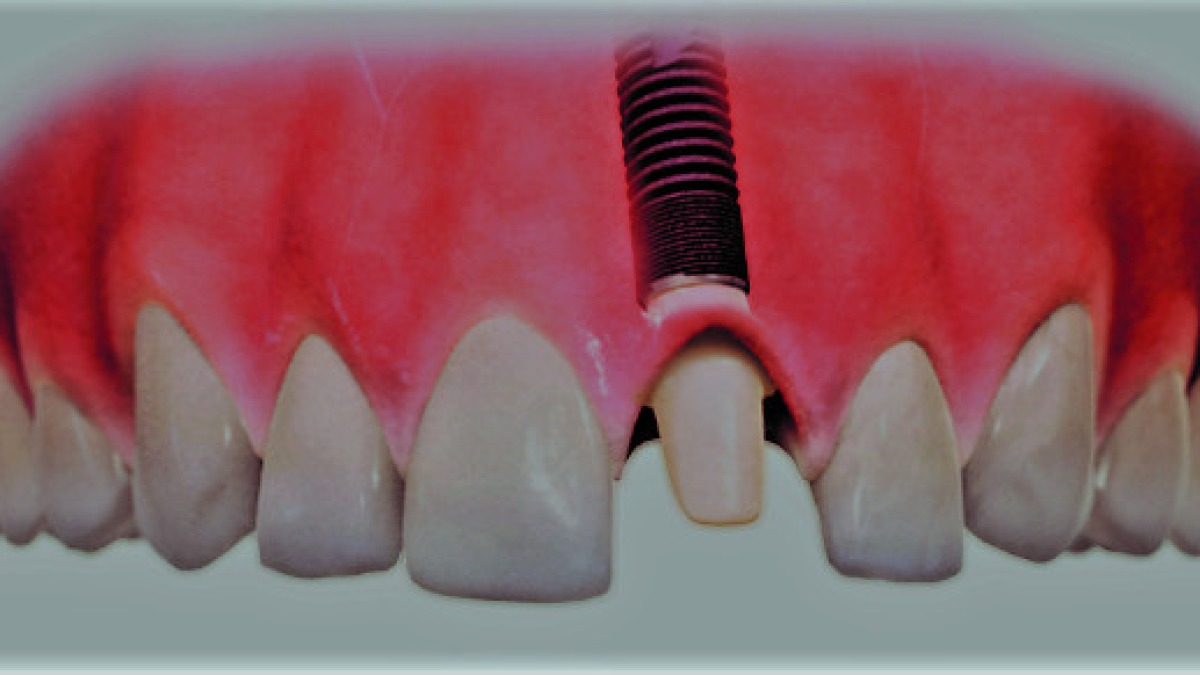 Was ist ein Implantat?