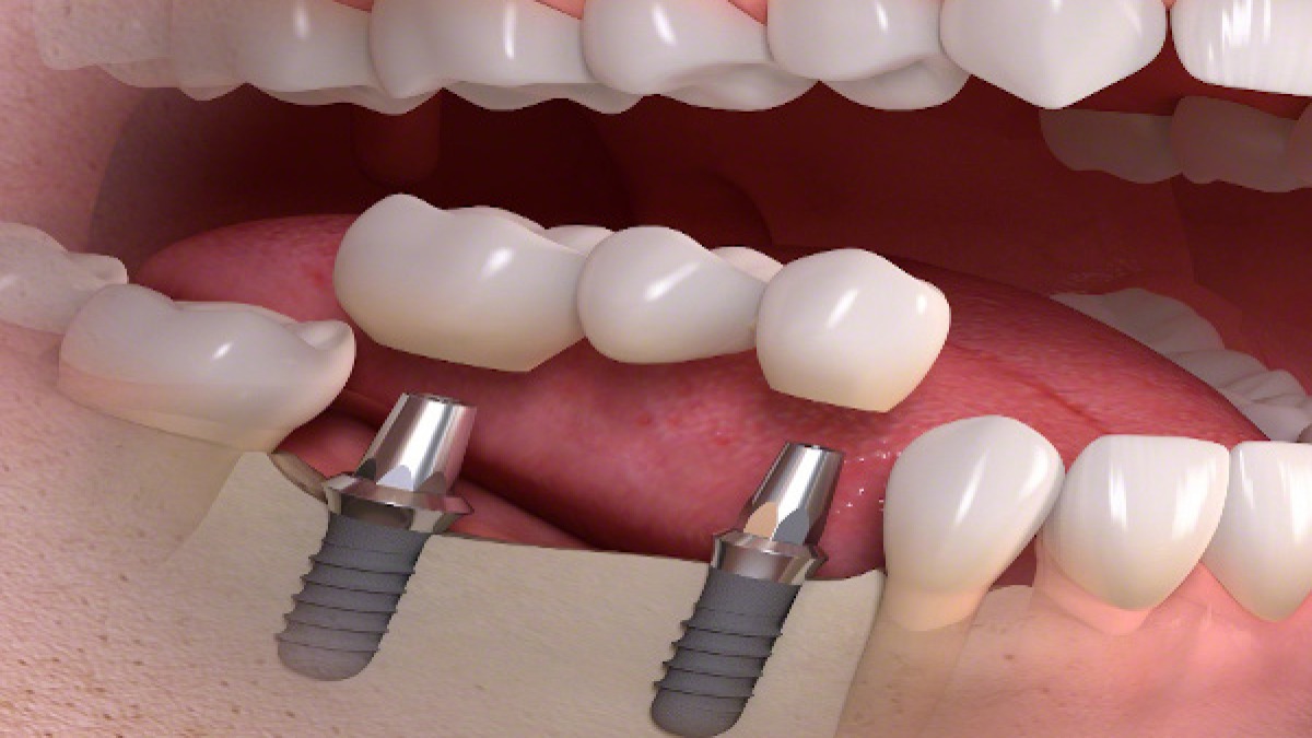 Wie wird das Implantat gesetzt?